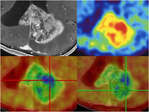 GdT1WI, FRP170, fusion imaging Beppu